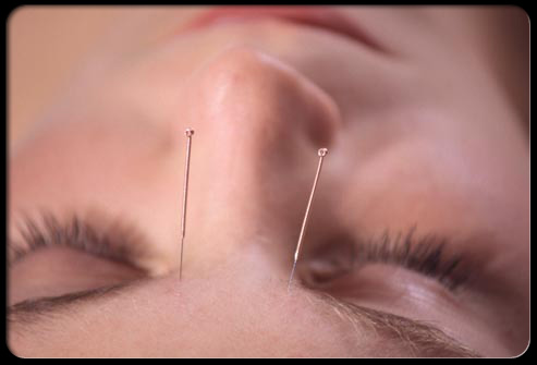 acupuncture-s5-photo-of--needles-in-forehead(2)