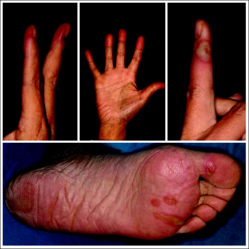 handen en voeten met hand-voet syndroom