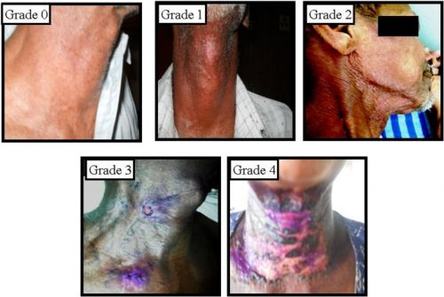 dermatitis door bestraling in hoofd halsgebied