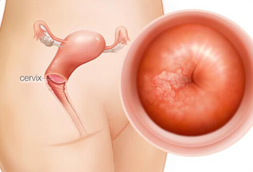 cervical-cancer-s2-illustration-of-cervical-cancer